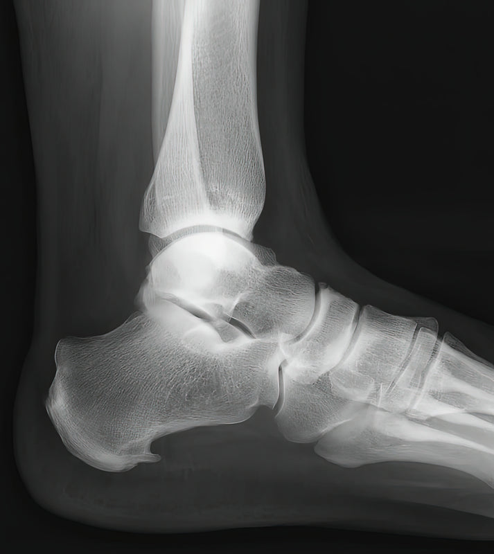 Heel Bone Spur Art Print | Medical Illustration Fine Art Print | RedKalion